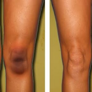 14 effective tips to get rid of black spots on the knees and elbows