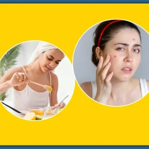 Try Out These Natural Supplements to Reduce Acne Scars